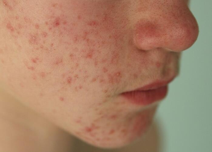 粉刺閉口應該如何處理？