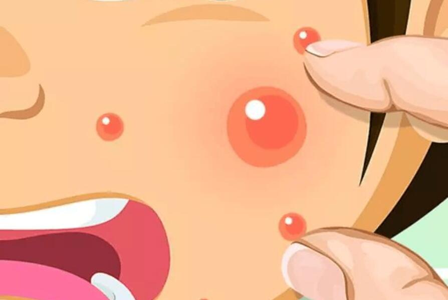 南寧皮膚管理專業(yè)：正確處理閉口的管理方法