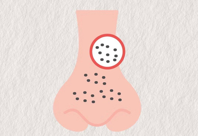 廣西皮膚管理師：面對嚴(yán)重的黑頭應(yīng)該怎么辦？